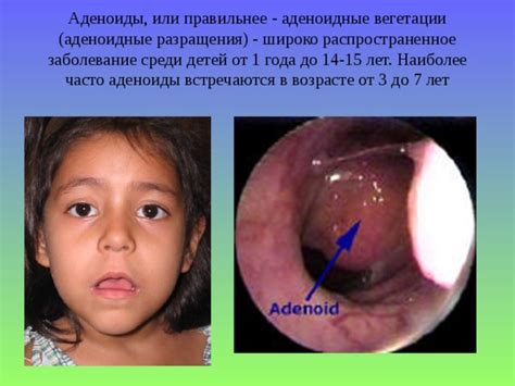 Аденоиды у детей до года: возможно ли?