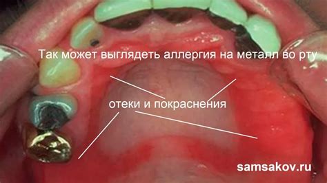 Аллергическая реакция на металл