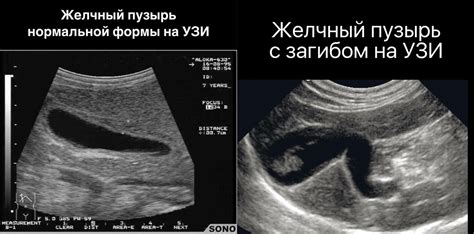 Альтернативные варианты физической активности при перегибе желчного пузыря