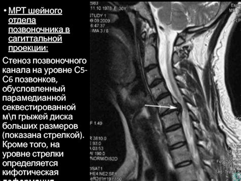 Альтернативные методы вправления грыжи шейного отдела