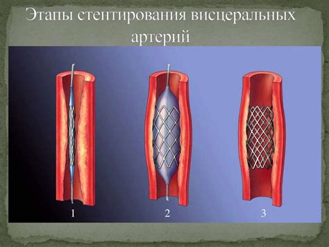 Альтернативные методы лечения при ограничениях для стентирования