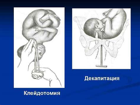 Альтернативные методы родоразрешения после трех кесаревых секций