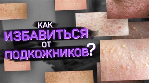 Альтернативные способы очищения закрытых комедонов на лбу