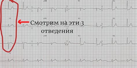 Анализ ЭКГ для построения треугольника Эйнтховена