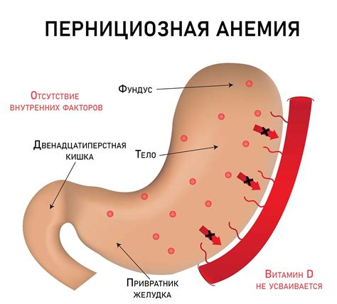 Анемия как фактор головокружения и тошноты при подъеме