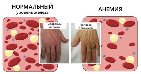 Анемия при нормальном гемоглобине