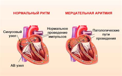 Аритмия: определение, причины, симптомы