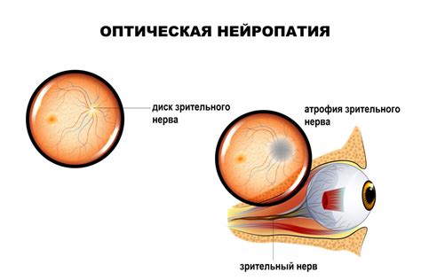 Атрофия зрительного нерва: причины и проявления