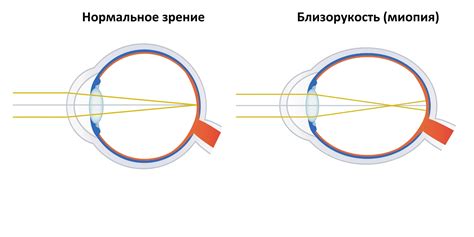 Близорукость: как эффективны очки?