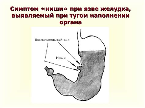 Было ли сало раньше запрещено при язве желудка?