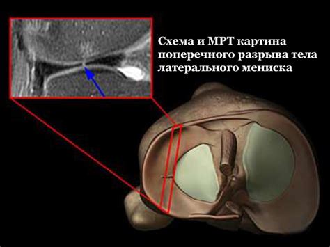 Важность и возможность шитья мениска коленного сустава