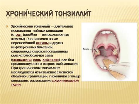 Взаимосвязь температуры и тонзиллита