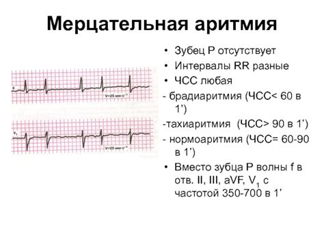 Виды мерцательной аритмии