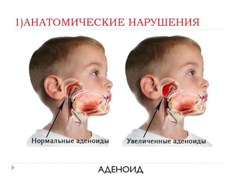 Влияние аденоидов на здоровье и поведение