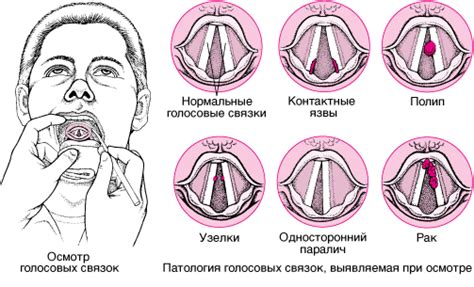 Влияние воспаления горла на голосовые связки