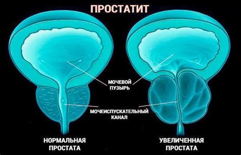 Влияние воспаления простаты на температуру тела