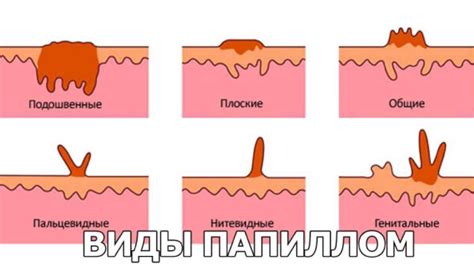 Влияние касторового масла на папилломы: миф или реальность?