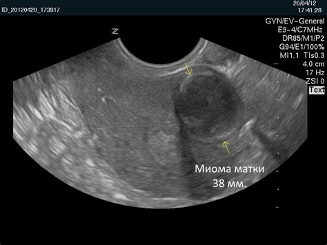 Влияние потери веса на размеры миомы