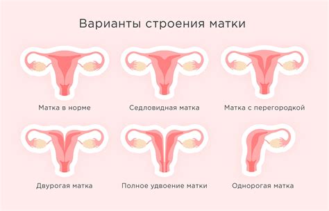 Внимание: двурогая матка - что это?