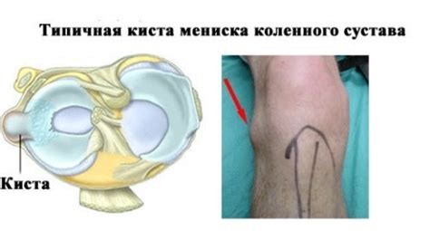 Возможные осложнения и риски шитья мениска коленного сустава