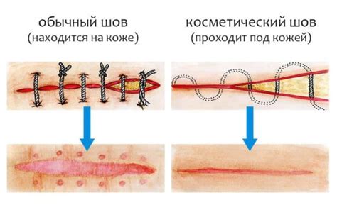 Возможные осложнения при неснятых швах после стерилизации