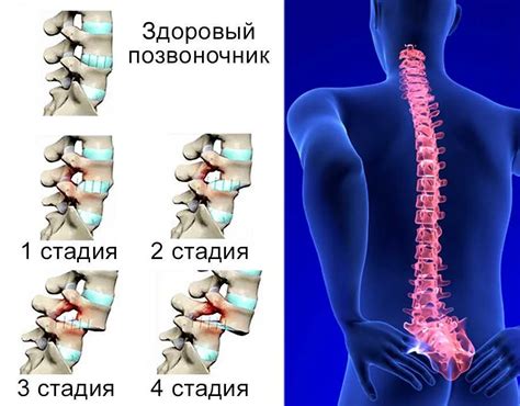 Возможные осложнения при смещении стента и как их избежать