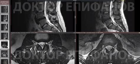 Возможные побочные эффекты при вправлении позвонков при грыже