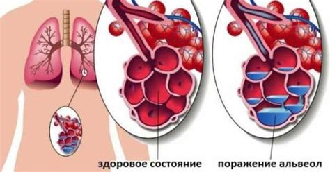 Возможные последствия нелеченого воспаления легких