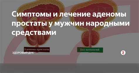 Возможные риски при массаже простаты при аденоме