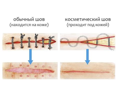 Возможные риски при неправильном снятии швов