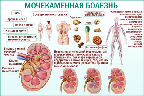 Возможные симптомы мочекаменной болезни