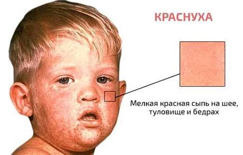 Возможны ли опасные последствия и осложнения от краснухи?