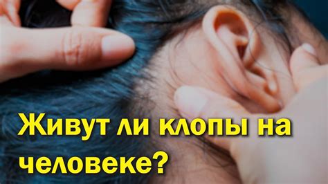 Встречаются ли клопы на человеке?