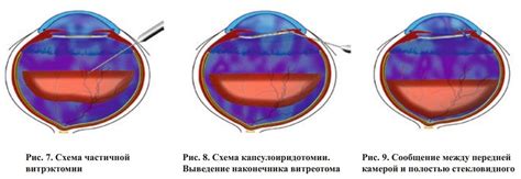 Выведение деталей глаза