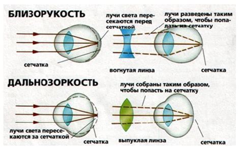 Дальнозоркость: выносить ли очки или нет?