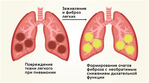 Действие медицинских банок при воспалении легких