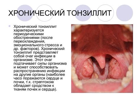 Действительно ли тонзиллит может передаваться полными губами?