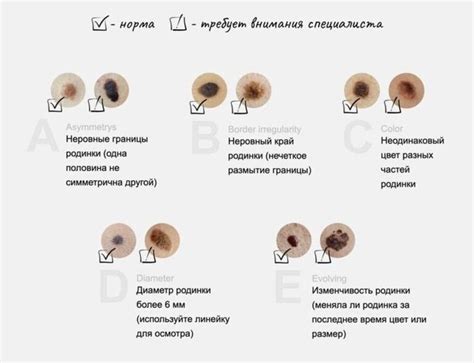 Диагноз меланомы и истончение волос: есть ли связь?