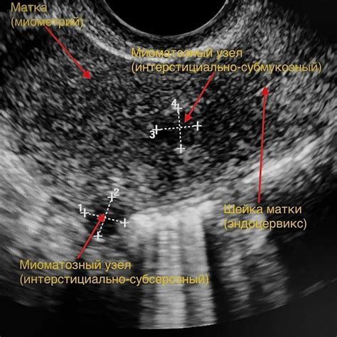 Диагностика и лечение миомы матки