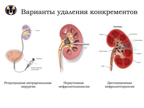 Диагностика камней в почках