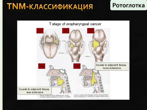 Диагностика опухоли гортани