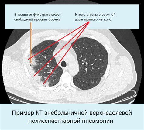 Диагностика пневмонии с помощью КТ легких