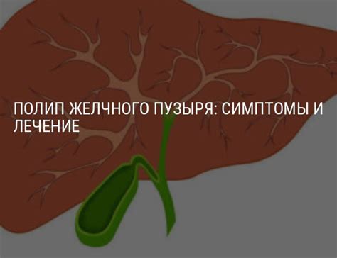 Диагностика полипа желчного пузыря