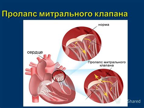 Диагностика пролапса митрального клапана