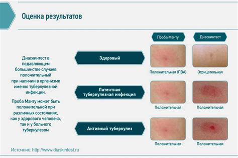 Диаскинтест: что это и как проходит?