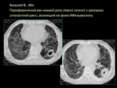 Для кого рекомендуется проводить КТ легких?