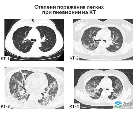 Есть ли вред от КТ легких?