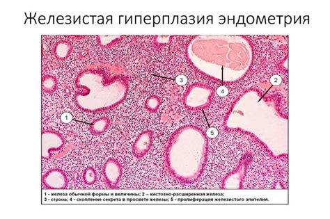 Железистая гиперплазия: понятие и причины