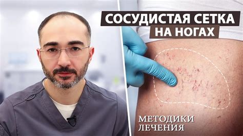 Забудьте о герпесе навсегда: эффективные и безопасные способы лечения