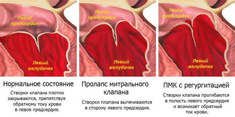 Значение УЗИ при уменьшении пролапса митрального клапана